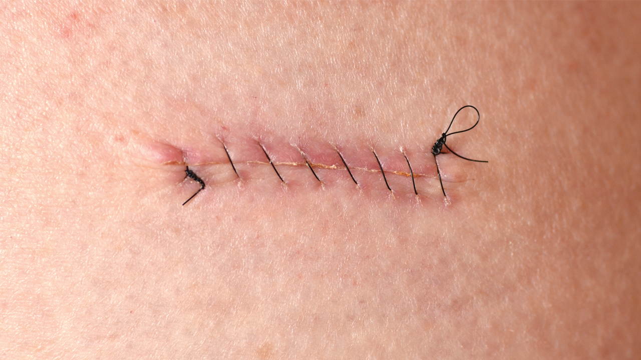 stitches