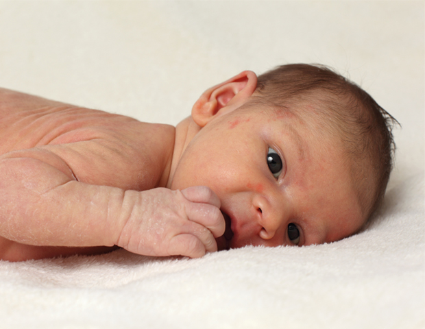 Eczema_baby_s.jpg